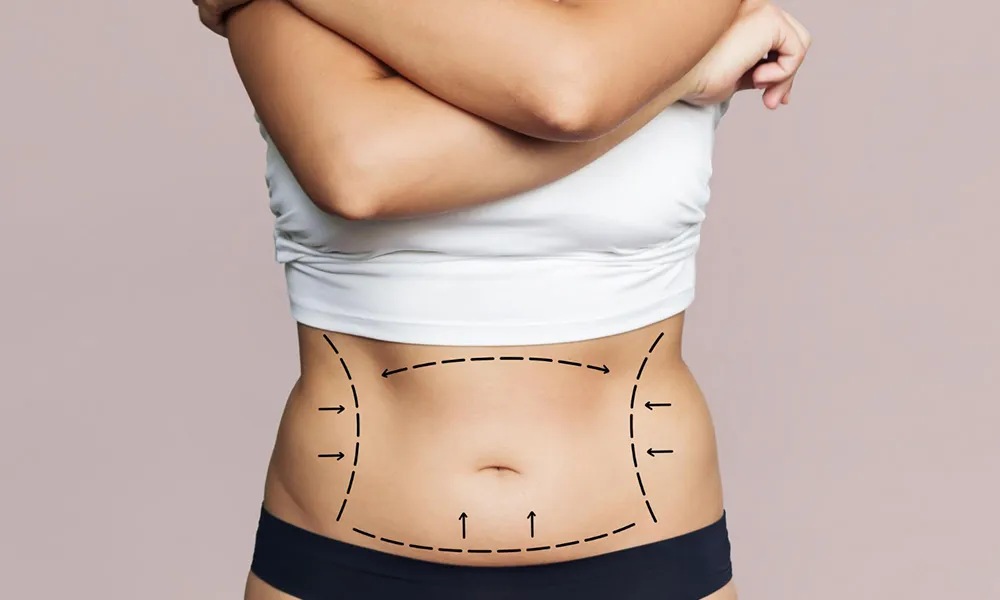 Tummy Tuck Surgery